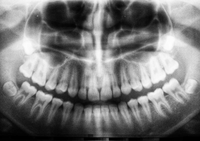 x-ray of teeth