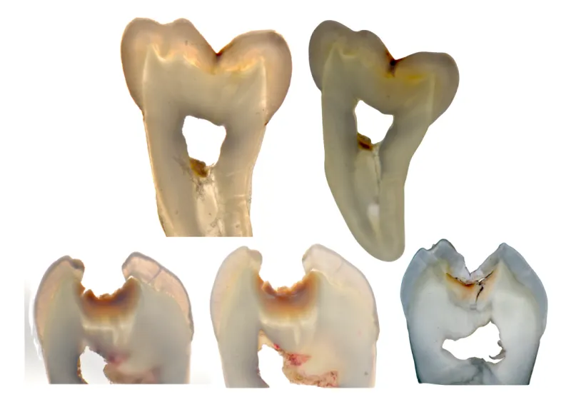 teeth grid
