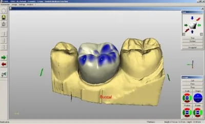 Zirconia CAD/CAM Systems